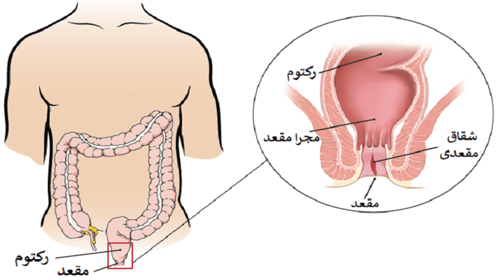 لیزر شقاق در مشهد