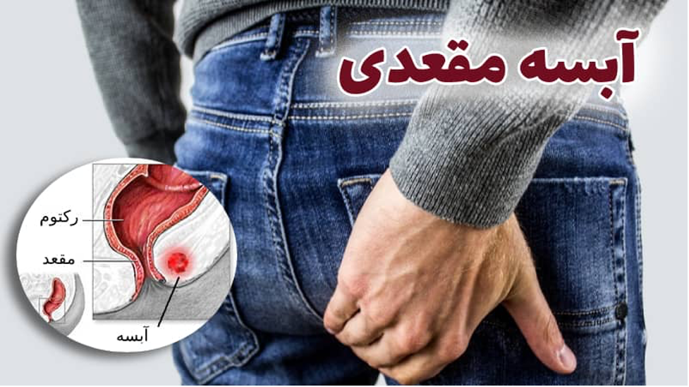 آبسه مقعد و درمان آن با لیزر در مشهد، به عنوان جدیدترین روش