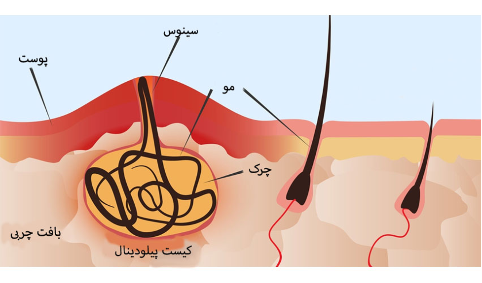 لیزر کیست مو در مشهد