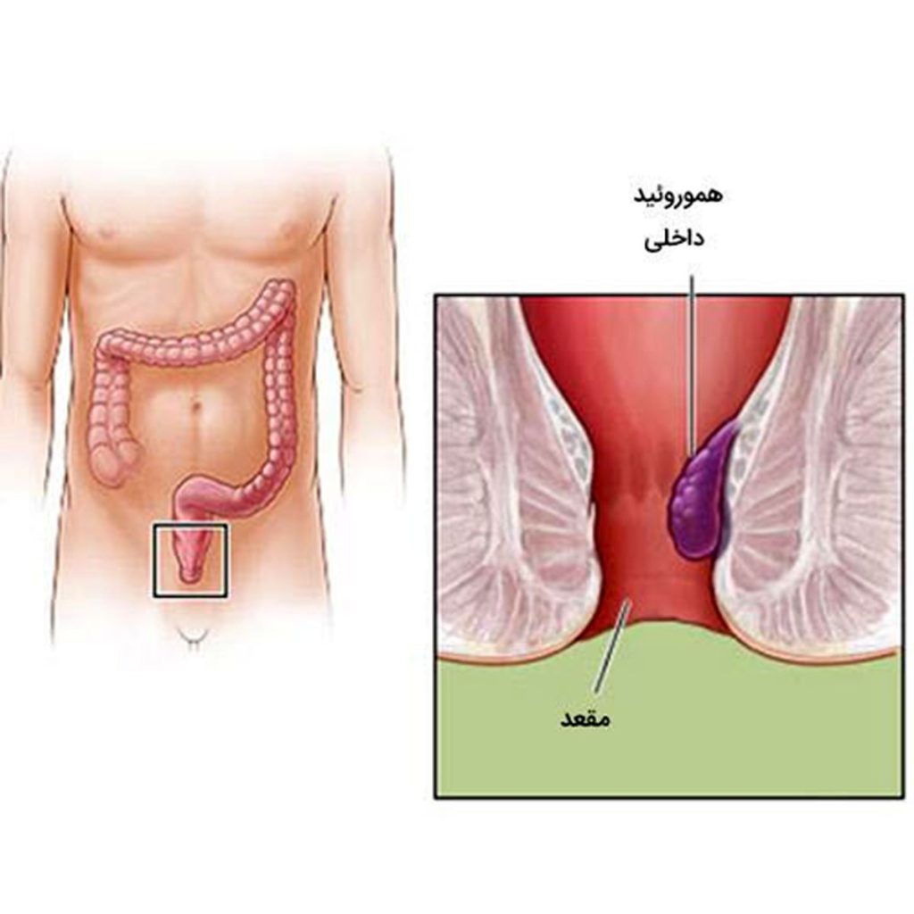 مرکز تخصصی درمان بیماری های نشیمنگاه