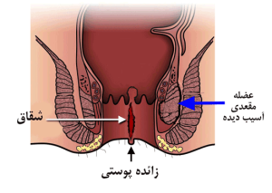 مرکز درمان نشیمنگاهی در مازندران